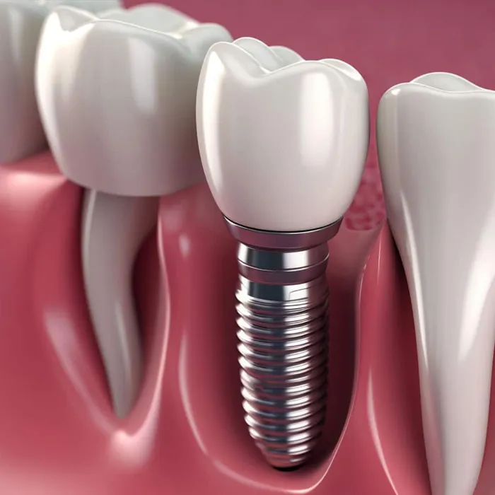 Les-avantages-de-l'implantologie